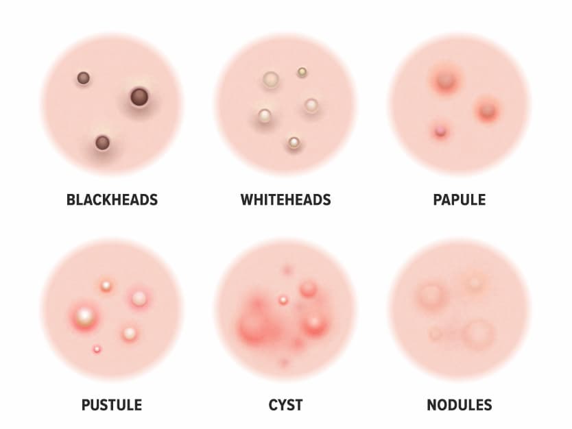 Different types of acne in men