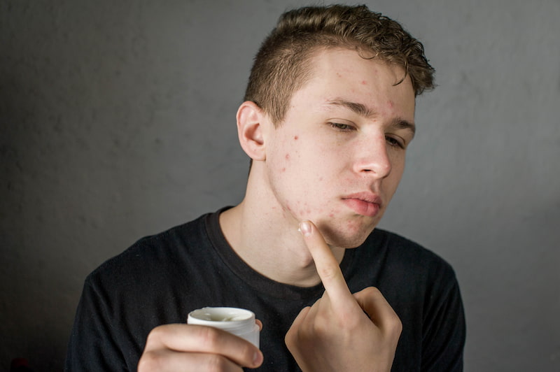 Does Acnecide Work? Does Acnecide Work? Man applying acnecide