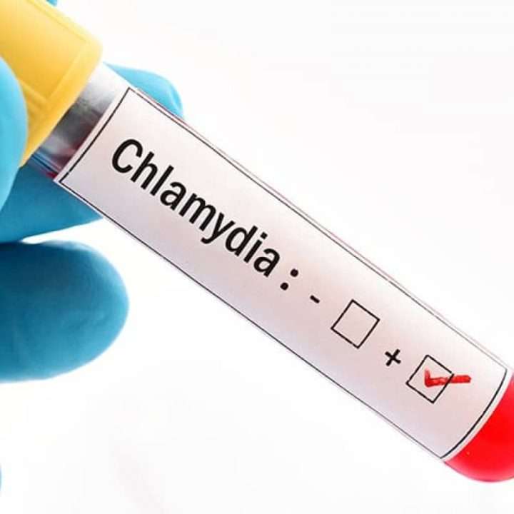 ᐅ Chlamydia The Silent STI Symptoms & Treatment ESurgery