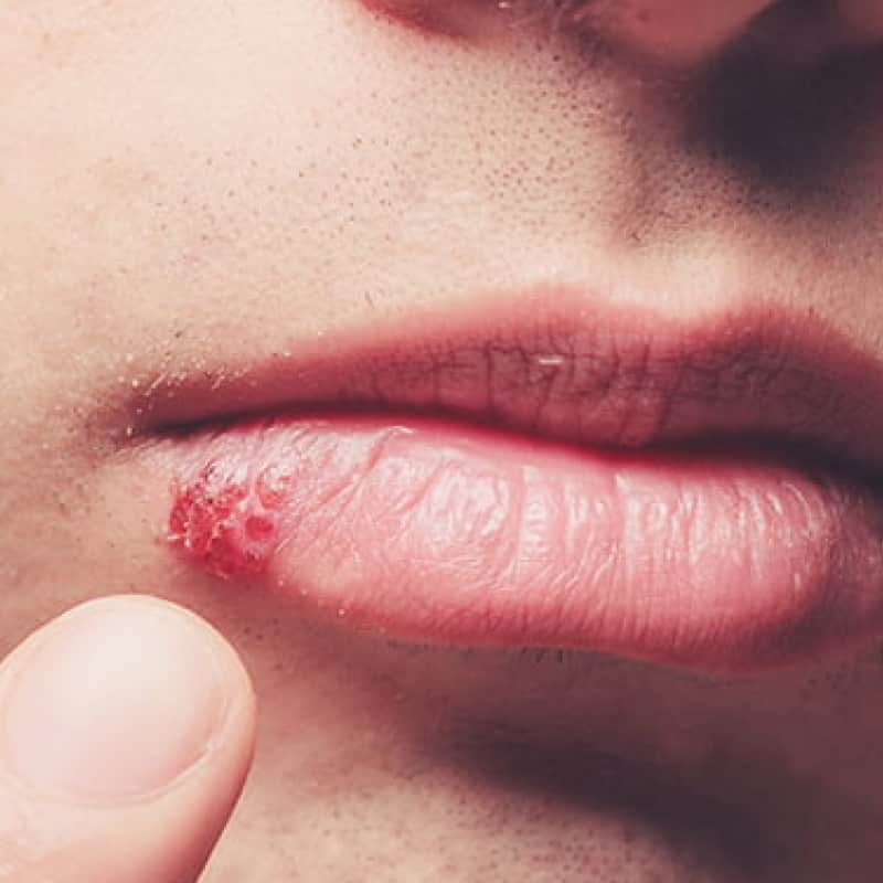 Close up of man pointing to herpes coldsore on lip, home remedies for herpes, e-Surgery