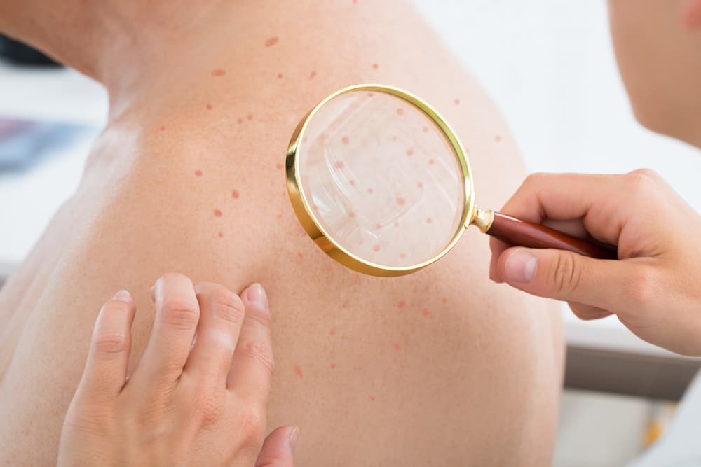 Doctor checking back of man with acne