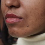 5 Natural Home Remedies For Acne Scars