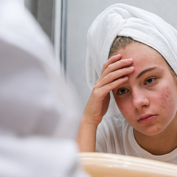 Girl Struggling with acne getting worse in the summer