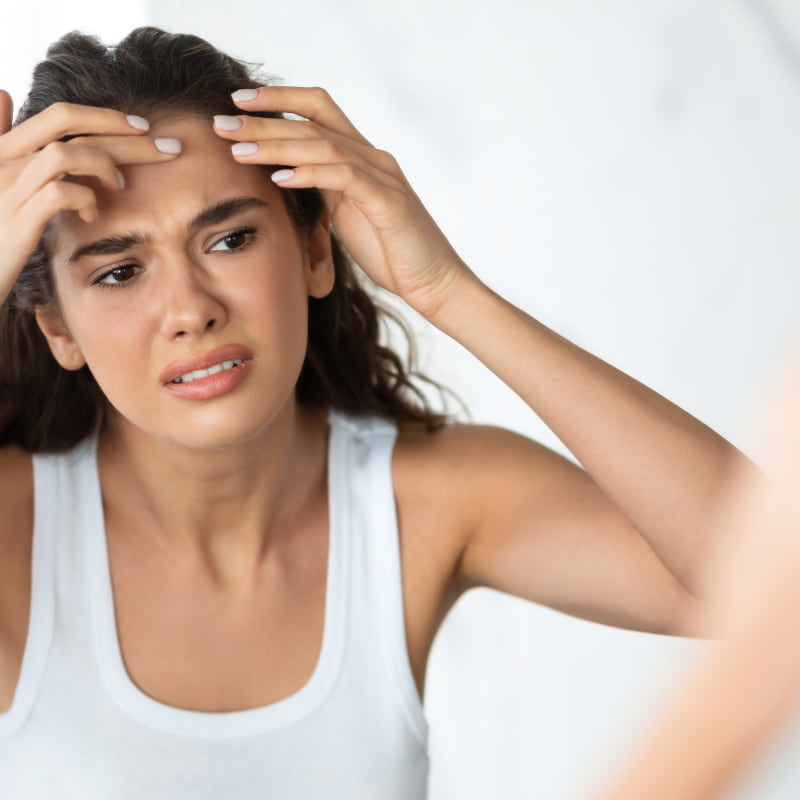 Woman in Summer with Acne getting worse