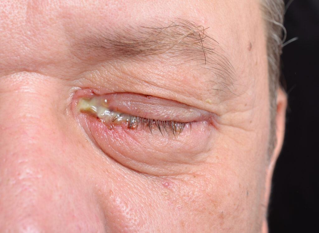 Pink Eye: Natural Remedies For Conjunctivitis | E-Surgery