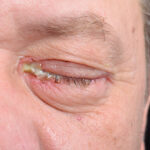 Say Goodbye to Pink Eye: Natural Remedies for Conjunctivitis