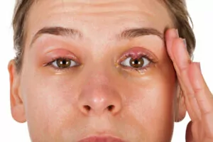 natural remedies for conjunctivitis