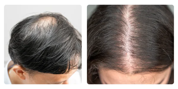 How Does Minoxidil Work for Hair Loss_ Understanding the Science Behind This Proven Treatment