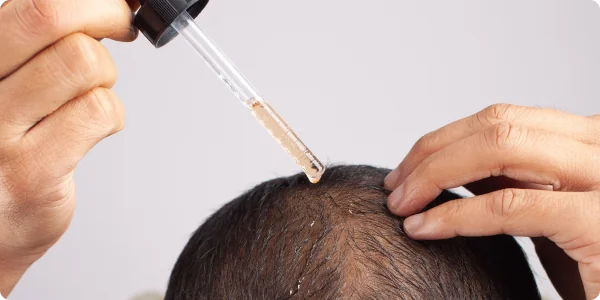 How Does Minoxidil Work for Hair Loss_ Understanding the Science Behind This Proven Treatment