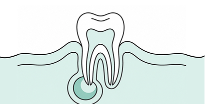 periapical abscess