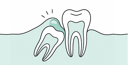 pericoronitis