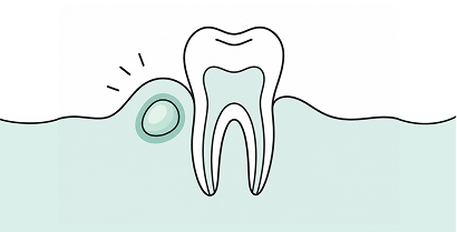 periodontal abscess